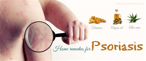 21 Easy Home Remedies For Psoriasis On Hands, Feet & Others