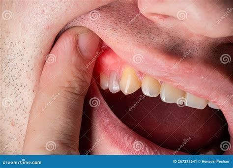 Red And Swollen Gums In A Man Gum Disease Gingivitis Flux And