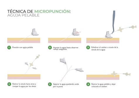 Canalizaci N Picc Neonatal Con T Cnica Microseldinger Aguja Rompible