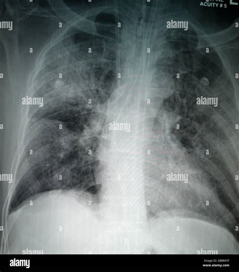 Radiografia Toracica Immagini E Fotografie Stock Ad Alta Risoluzione