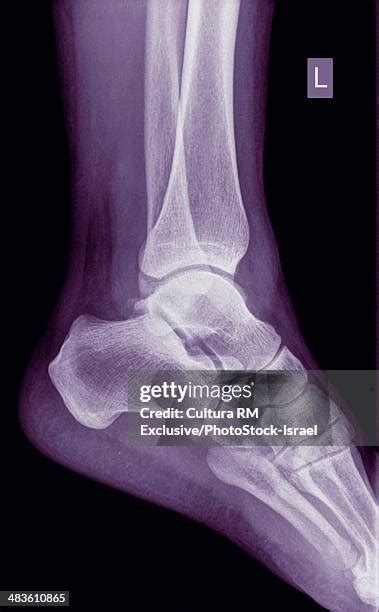 Medial Malleolus Photos and Premium High Res Pictures - Getty Images