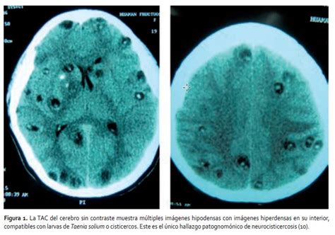 Treinta Ejemplo Síguenos Parénquima Cerebral Anatomía Para Justificar