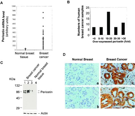 High Levels Of Periostin Expression Are Associated With Human Breast