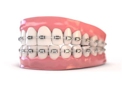 Light Pink Braces