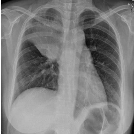 Initial chest X-ray shows right upper lobe collapse with bulging... | Download Scientific Diagram