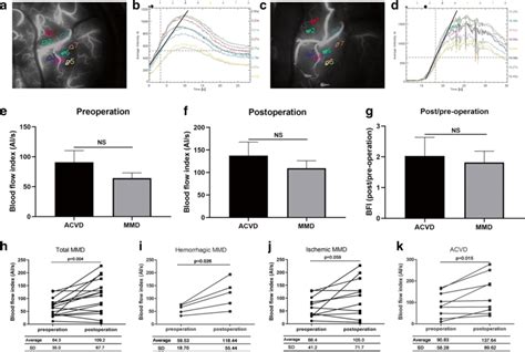 Intraoperative Cortical Perfusion Analysis Assessed By Icg