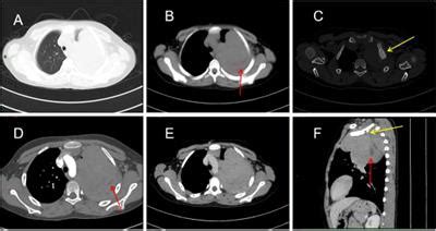 Frontiers Case Report Primary Pleural Giant Extraskeletal Ewing