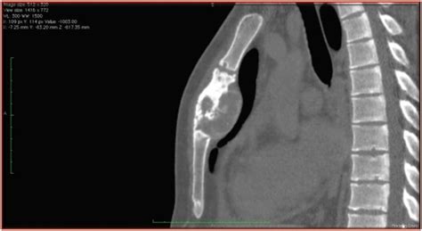 Osteomyelitis Of The Sternum In Hiv Patient Download Scientific Diagram