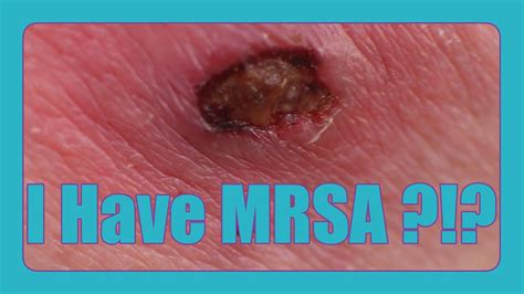 I Have Mrsa What Im Doing About It Home Remedy Curing With Coz Youtube