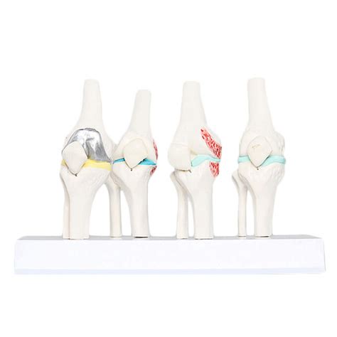 Buy K Knee Joint Model Set Of Stage Osteo Knee Joint Model