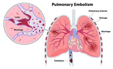 Can Pulmonary Embolism Cause PH? Lung Sounds and More | myPHteam