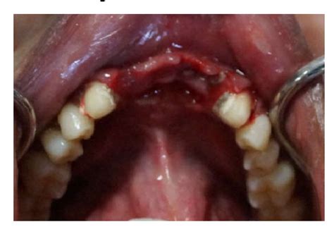 Figure 1 From Management Of Pontic Induced Reactive Hyperplastic