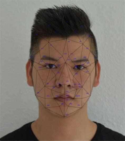 Distinctive facial features in idiopathic Moyamoya disease in