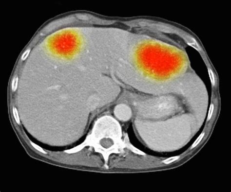 Ablaci N Por Microondas El Paso Tx Imaging Interventional Specialists