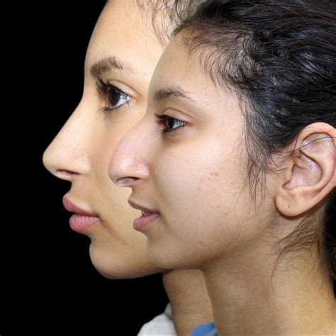 Rhinoplasty Before And After Photos Forbest Clinic