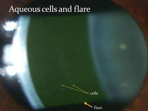 Overview Of Uveitis Part2 Clinical Features