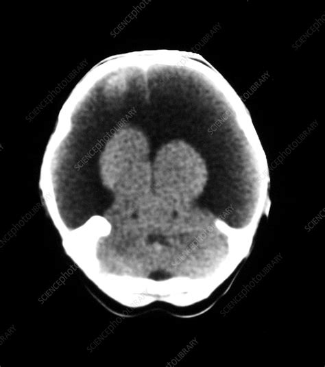 Ct Image Of Hydranencephaly Stock Image M1700424 Science Photo