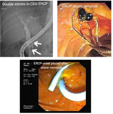 Figure 1 from Gallstone and Gallstone Related Complications in Pregnant ...