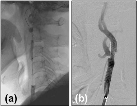 A Proximal Occlusion Balloon Guiding Catheter Is Inserted Into The