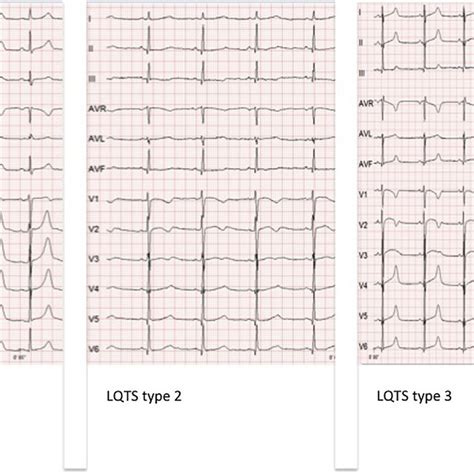 Diagnostic Criteria For Brugada Syndrome Diagnostic Ecg Criteria One Of