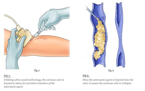 Varicose Veins Injection Treatment Or Sclerotherapy Hyderabad Reva