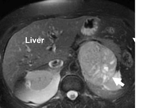 The adrenal gland is to the kidney - horei