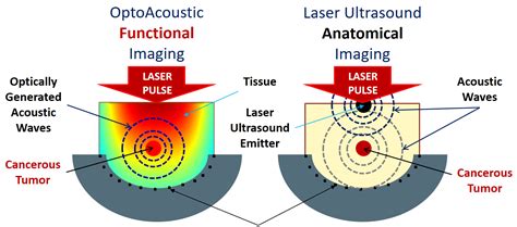 Advanced LASER Ultrasound Imaging for Image-Guided Surgery