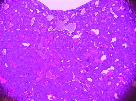 Cystic Parathyroid Adenoma Hande 40 Cells With Small Round Monomorphic