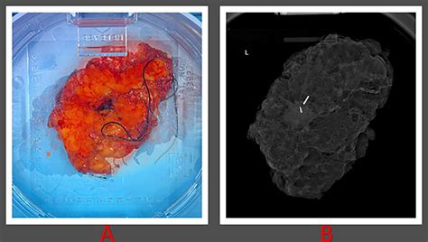 Frontiers Case Report Can Targeted Intraoperative Radiotherapy In