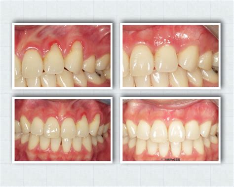 Gum Grafting For Gum Recession Treatment Gingival Graft Dr Noroozi