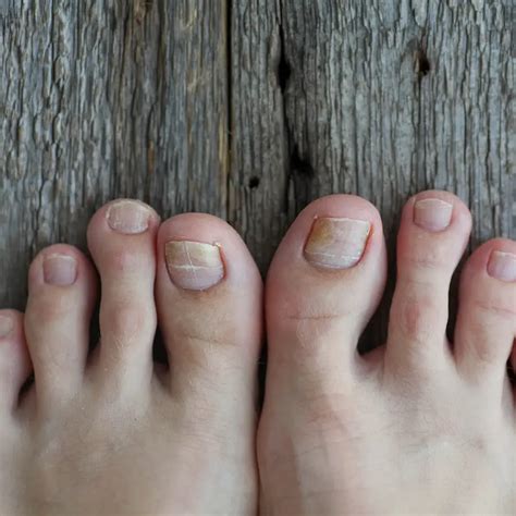 10 Signs of a Fungal Nail Infection and its treatment - Appleton Footcare