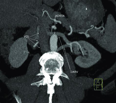 Oblique Axial Mip Image In Arteriel Phase Clearly Shows Circumaortic