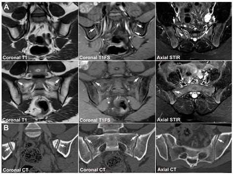 Jcm Free Full Text Diagnostics Of Sacroiliac Joint Differentials To Axial Spondyloarthritis