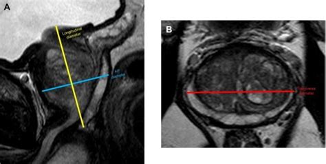 Prostate Volume And Psa Density Calculator Radiogyan