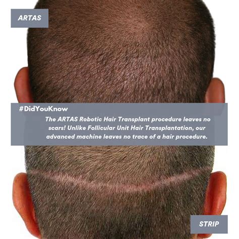 hair transplant scar repair - Cinda Bonner