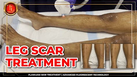 Leg Scar Treatment AFT Laser Light Skin Centre YouTube