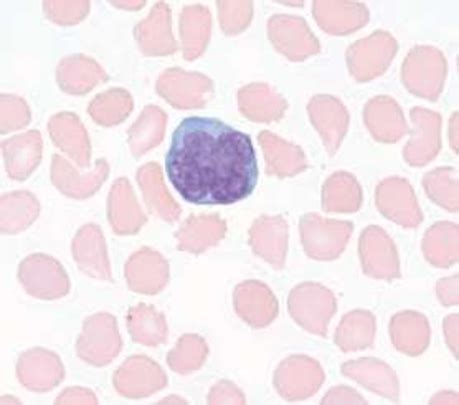 Flower Cell In Blood Smear Of Human Patient With ATL Adult T Cell