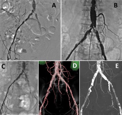 Angiography And Endovascular Therapy For Aortoiliac Artery Disease