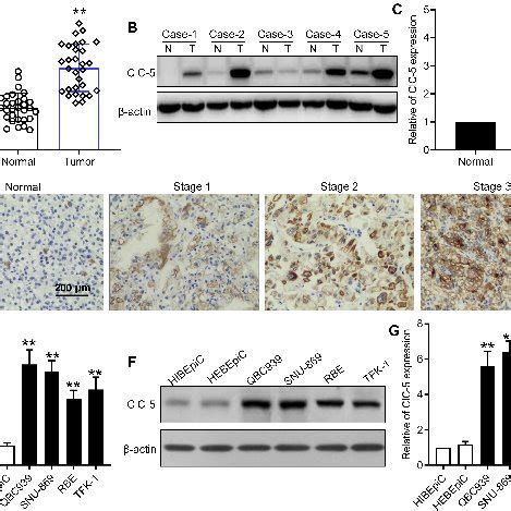 Clc Expression Was Up Regulated In Human Cca Tumor Tissues And Cca