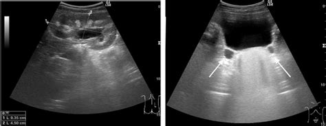 Bilateral Medullary Nephrocalcinosis Hydronephrosis And Hydroureters