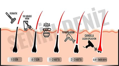 Genital Bölge Lazer Epilasyon Rehberi Detaylı Anlatım Yorumlar