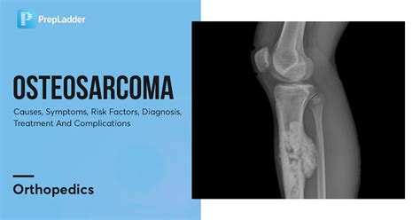 Osteosarcoma: Causes, Symptoms, Risk Factors, Diagnosis, Treatment and ...