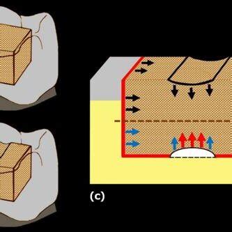 The Conventional Bulk Fill Resin Composite Filling Technique A