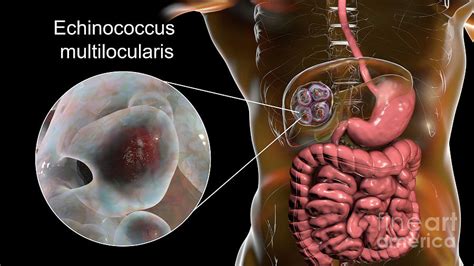 Hydatid Disease In Liver Photograph By Kateryna Kon Science Photo