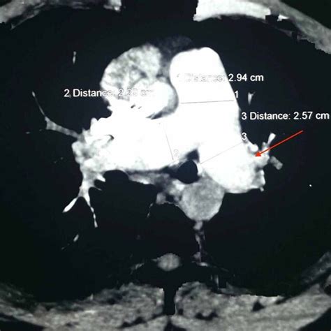 Axial Section Of Ctpa Showing Minimal Reduction In Size And Extent Of