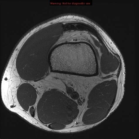 Knee Mri Anatomy Axial 14 Diagram Quizlet