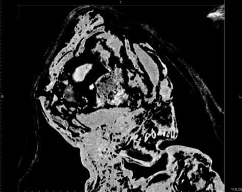 Coronal View Of A Ct Scan Of Clonycavan Man Download Scientific Diagram