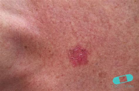 Online Dermatology Squamous Cell Carcinoma