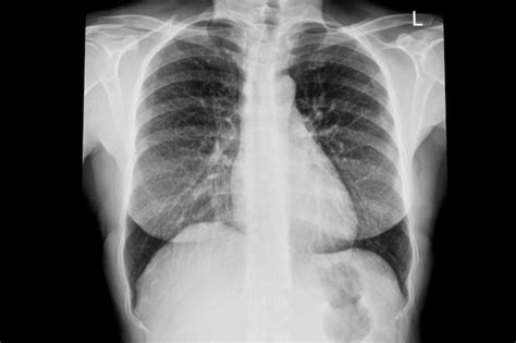 Imagen Normal De Radiografía De Tórax Demostrada Corazón Pulmones