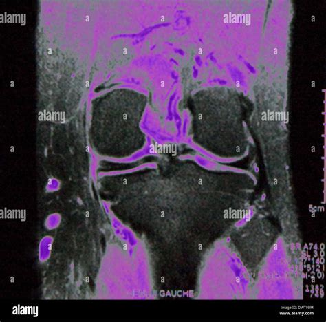 Resonancia Magn Tica De Rodilla Fotograf A De Stock Alamy